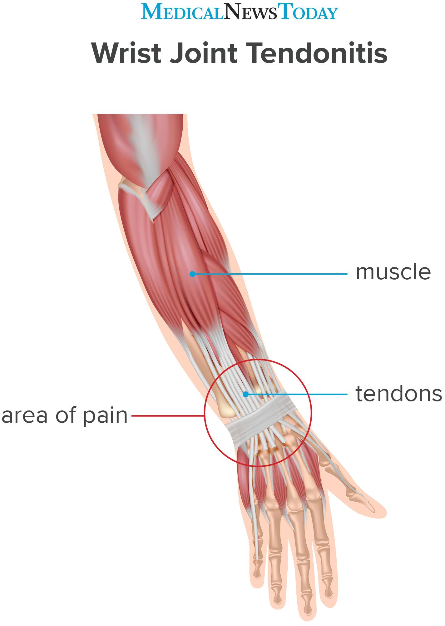 What to know about wrist tendonitis